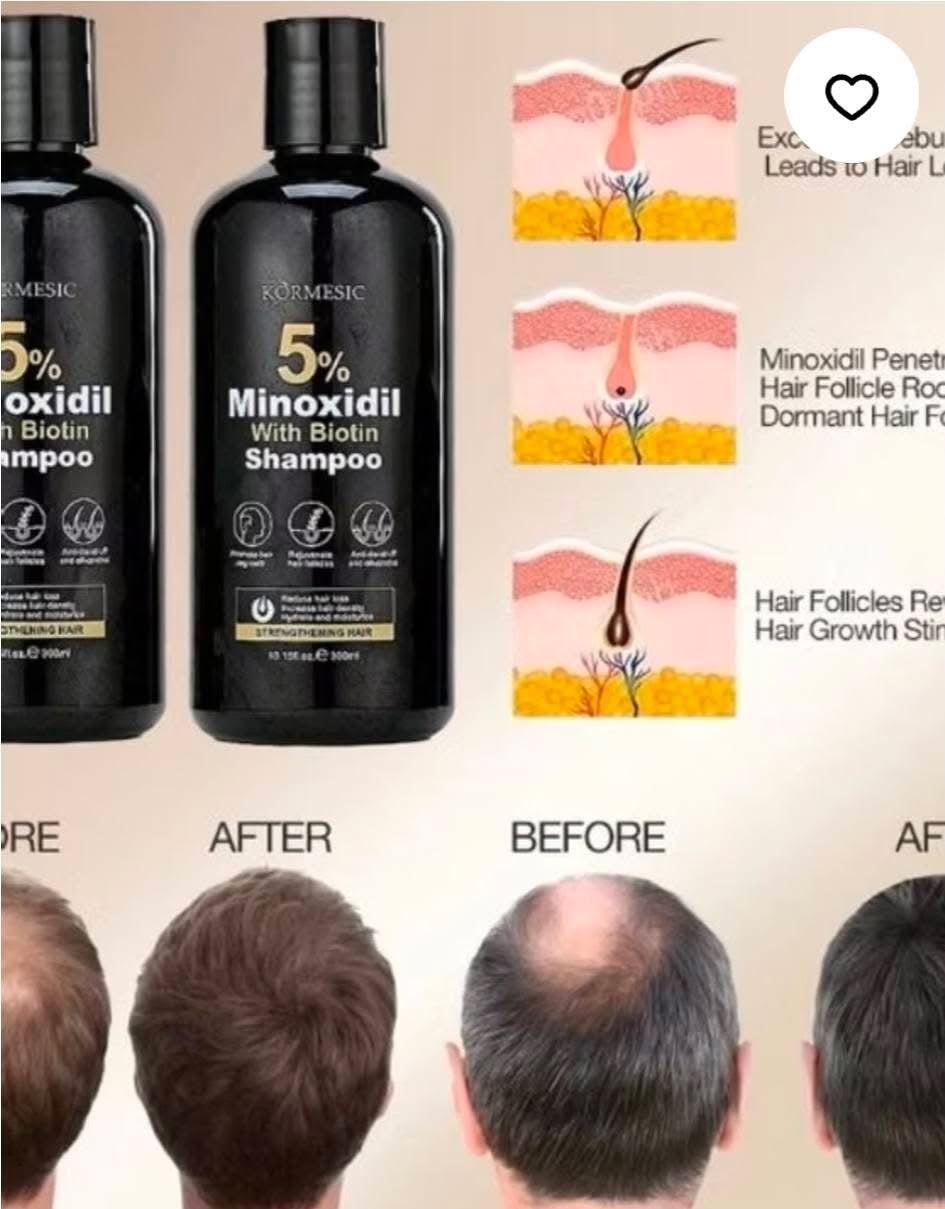 Kormesic Minoxidil 5% Biotin Hair Growth Shampoo And Conditioner 300ml
